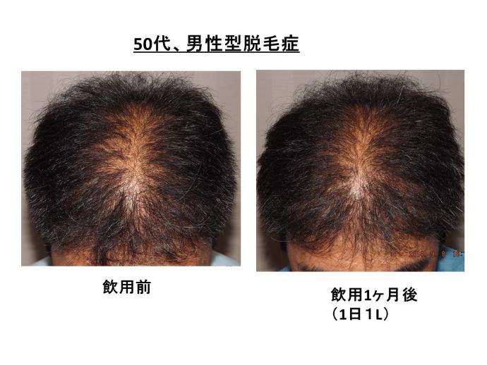 円形脱毛症　病院